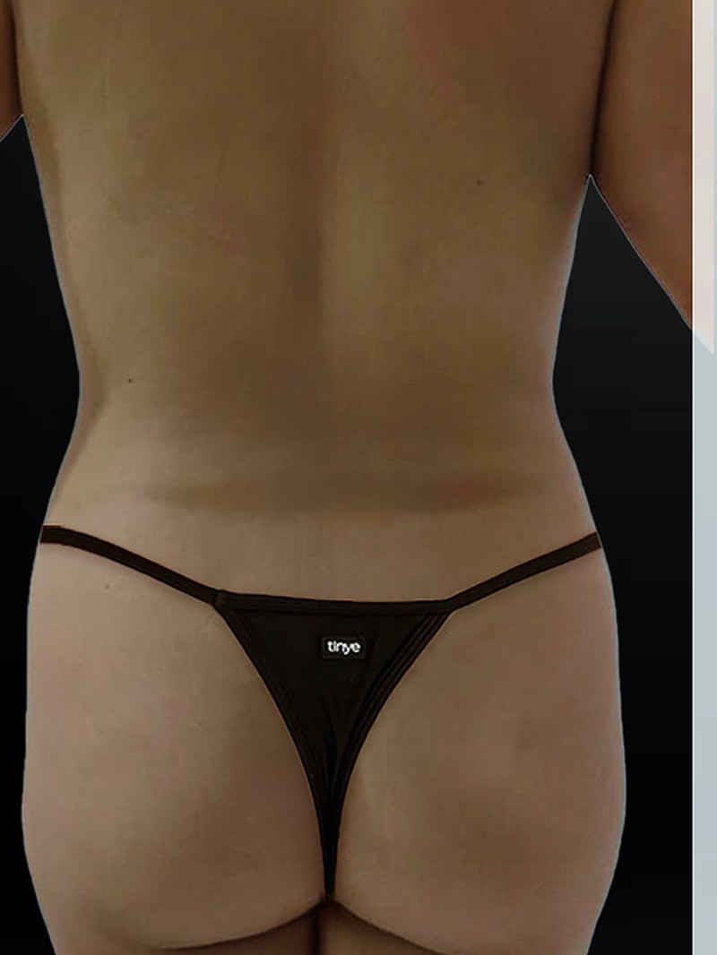 Brazilian Butt Lift, before