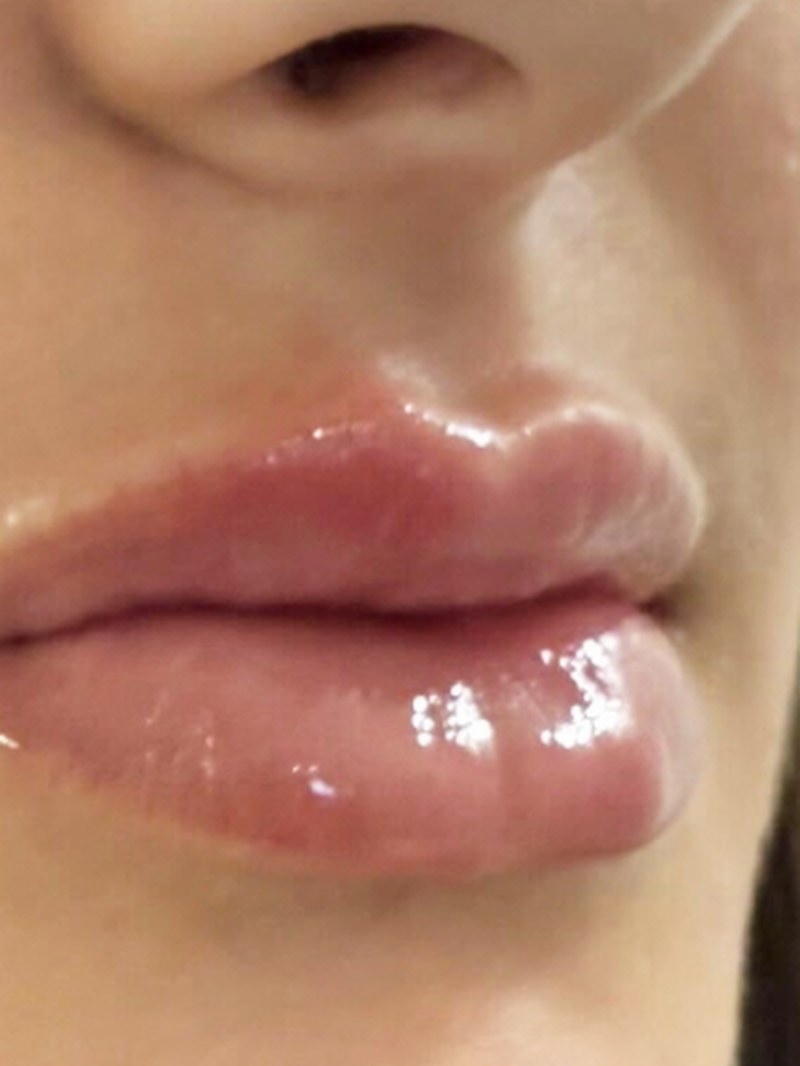 Facelift, after