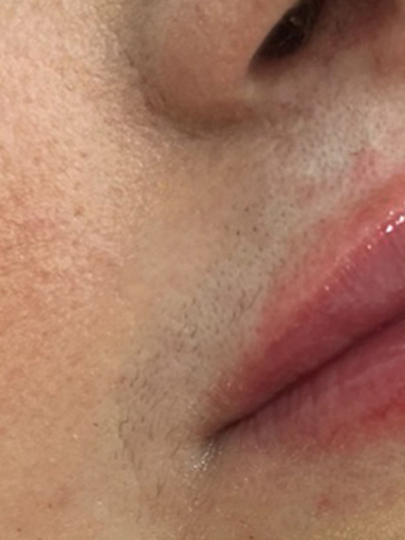 Injectables, after