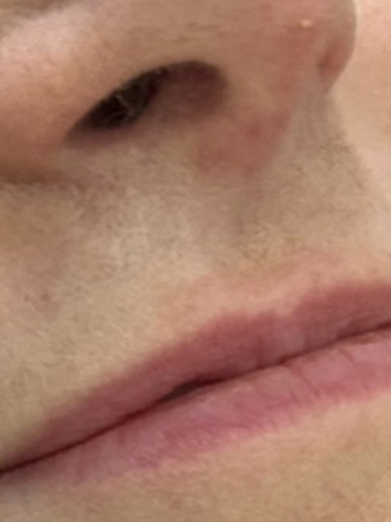 Injectables, before