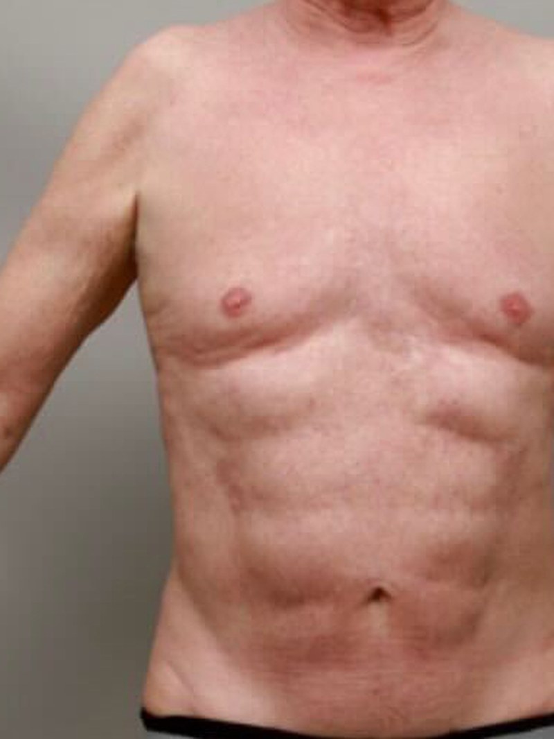 Lipo 360, after