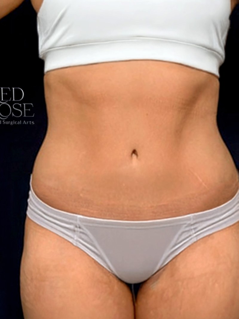 Tummy Tuck, after