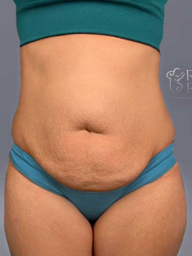 Tummy Tuck, before